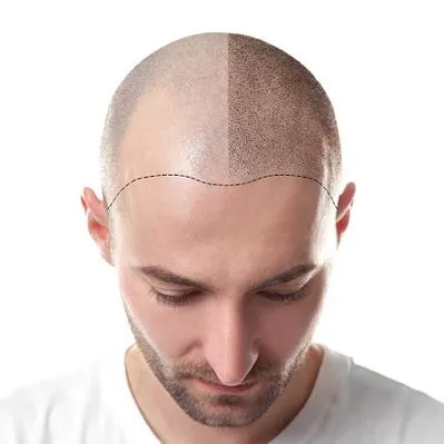 Male Hair Transplant